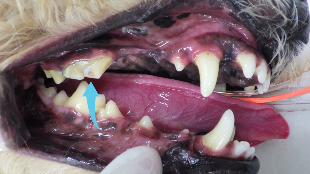 複雑性破折 + 露髄