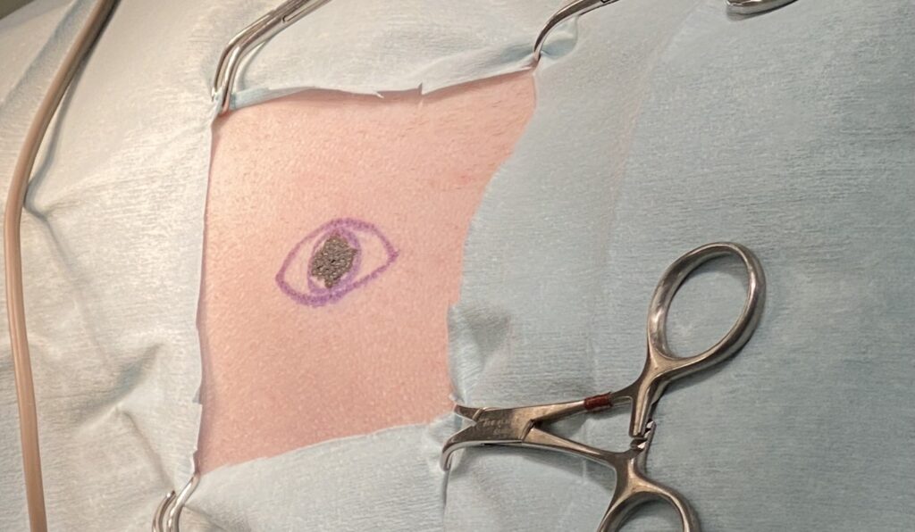 黒色腫の手術前の様子